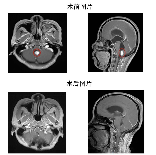 李大姐術(shù)前術(shù)后影像圖片對(duì)比.jpg