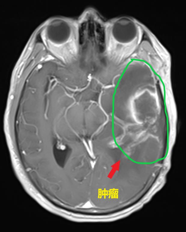 1,、患者漆大叔腦部的膠質(zhì)瘤.jpg
