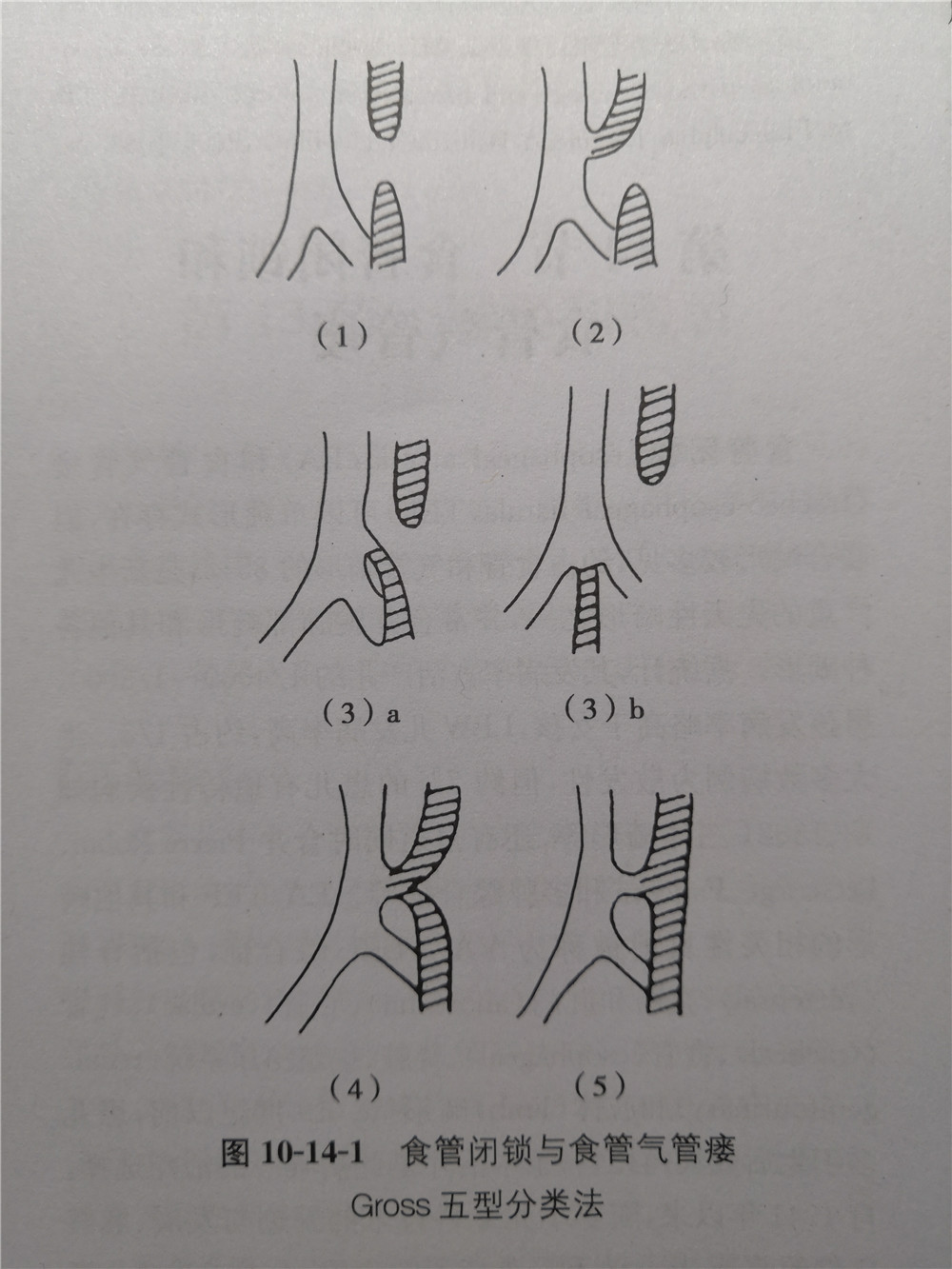 4,、食道閉鎖與食管氣管瘺Cross五型分類法.jpg