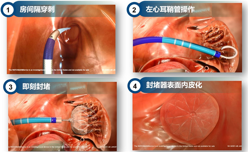 3,、經(jīng)皮左心耳封堵術簡易流程.jpg