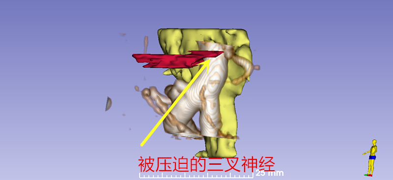 三維重建被壓迫三叉神經(jīng).png