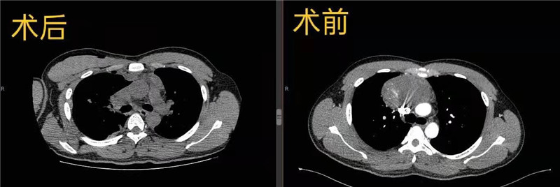 手術(shù)前后對比.jpg