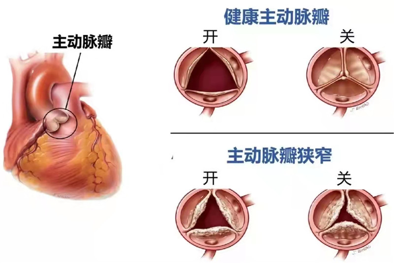 8,、主動(dòng)脈瓣圖解.jpg