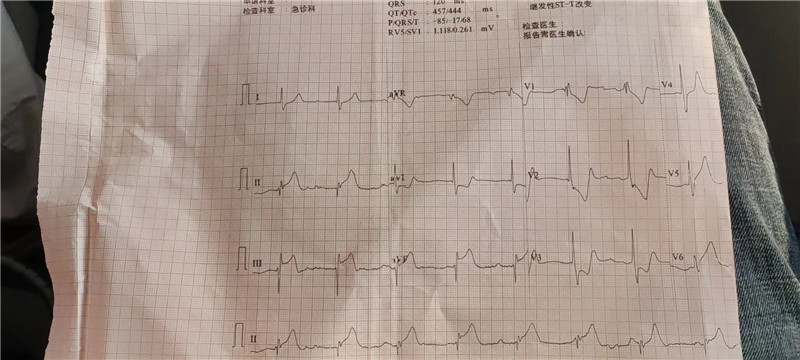1院前心電圖提示急性下壁心肌梗死.jpg