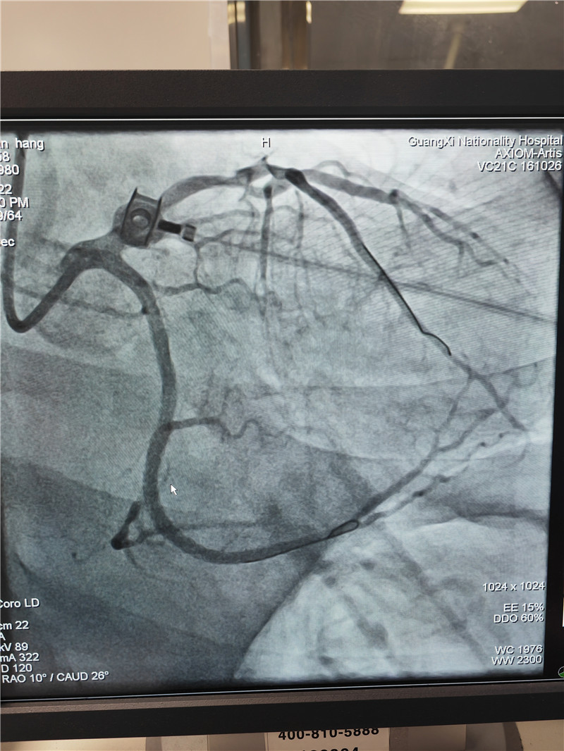 6PCI后復(fù)查造影結(jié)果，回旋支再通.jpg