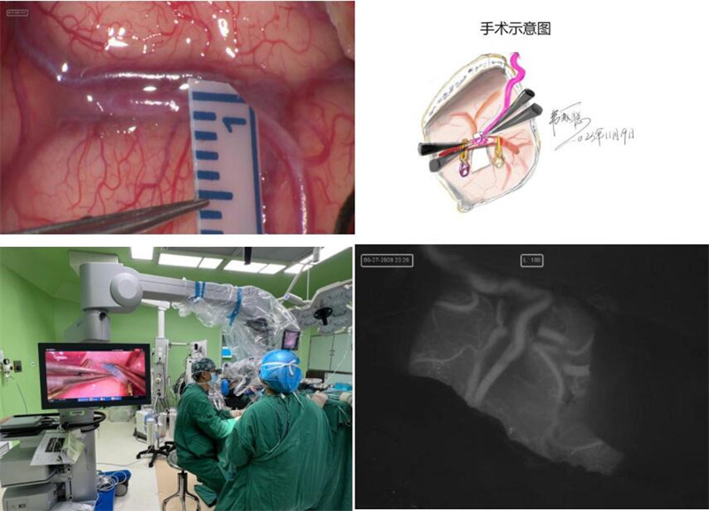 2術(shù)中熒光顯影提示顳淺動脈頂支與受體腦動脈血流通暢.jpg